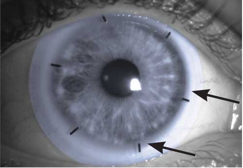 icd 9 code for scleral icterus
